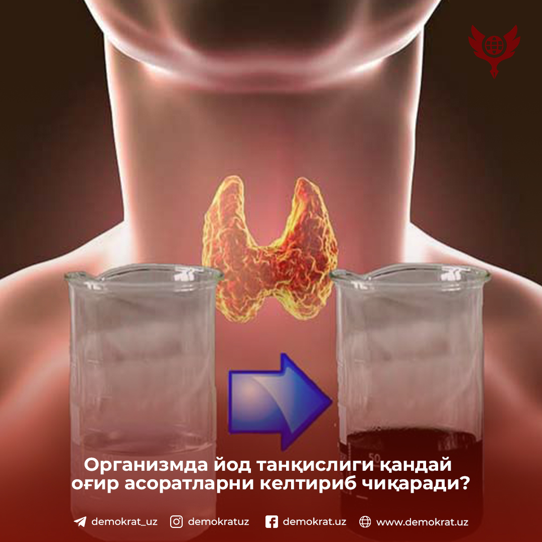 Организмда йод танқислиги қандай оғир асоратларни келтириб чиқаради?